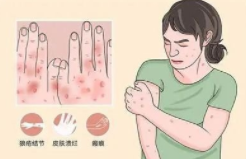 中国系统性红斑狼疮（SLE）患者数量及药物治疗市场现状，生物药市场占比提升「图」