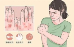 中国系统性红斑狼疮(SLE)患者数量及药物治疗市场现状,生物药市场占比提升「图」