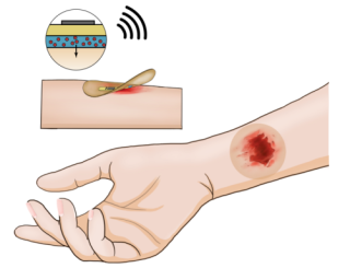 结合无线电刺激和生物传感器，智能绷带促伤口无痕修复